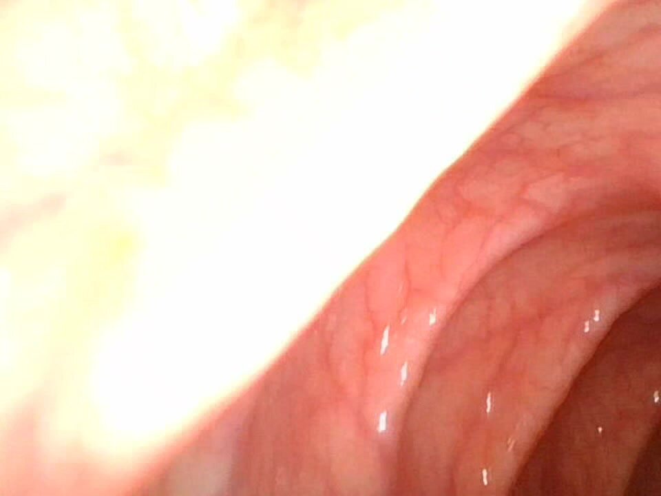 Endoscopy deep inside my girlfriend's colon - video 5
