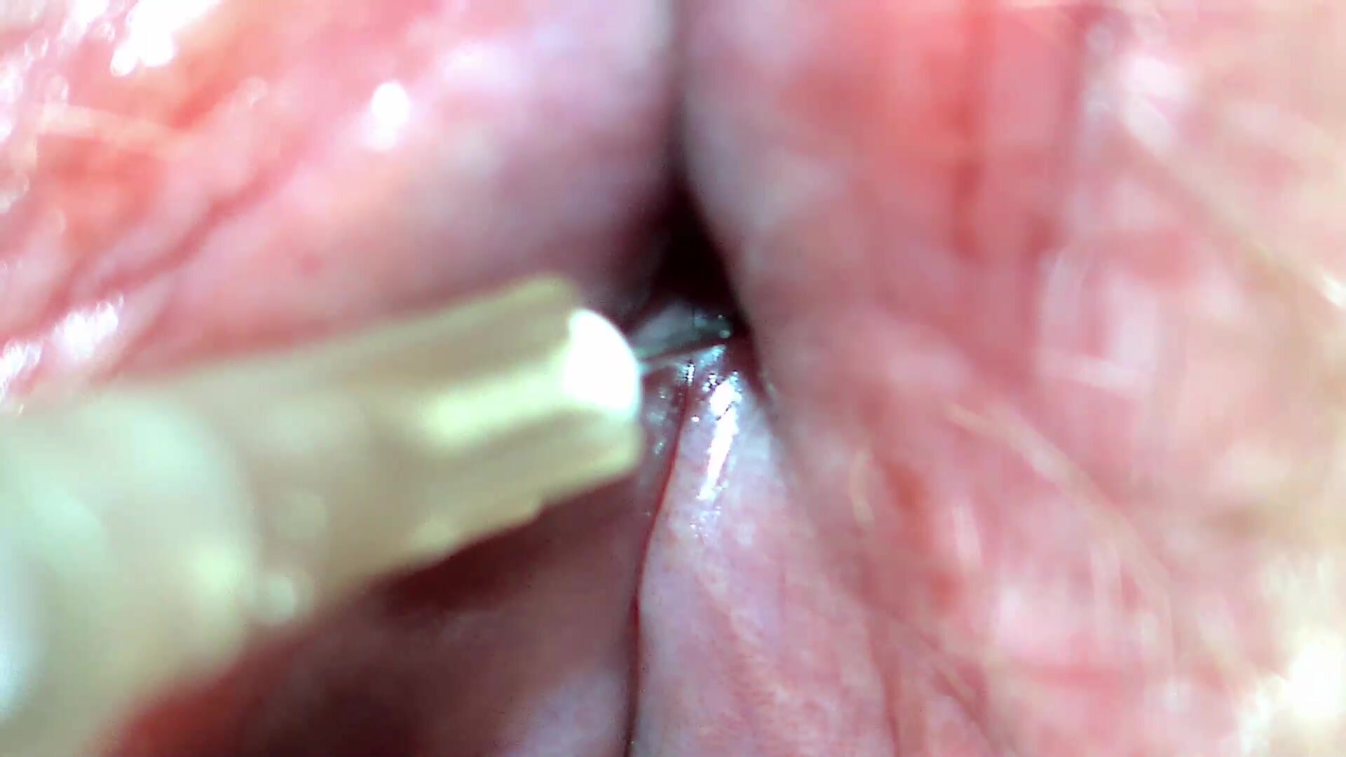 Injection in Anus with short needle (Extreme Closeup)