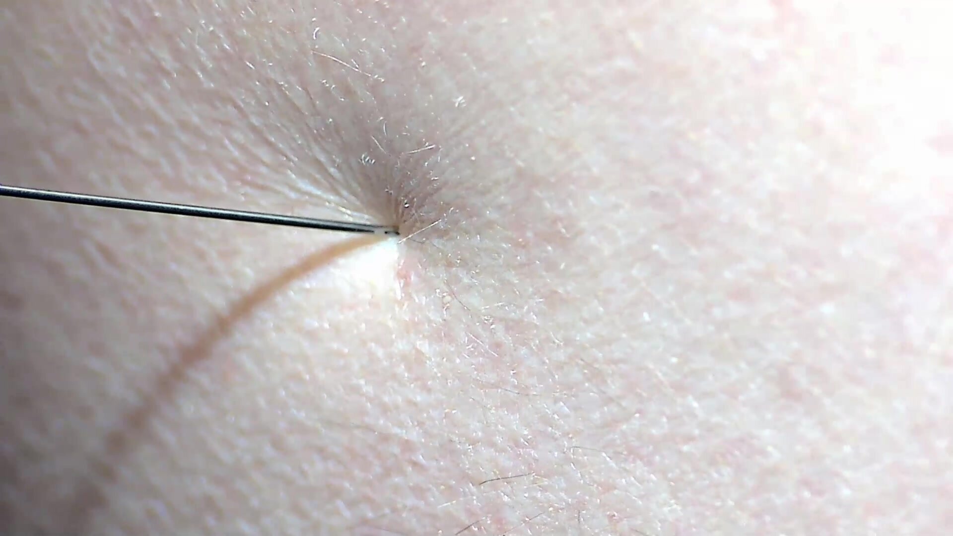 Injection in buttock (Extreme Closeup)