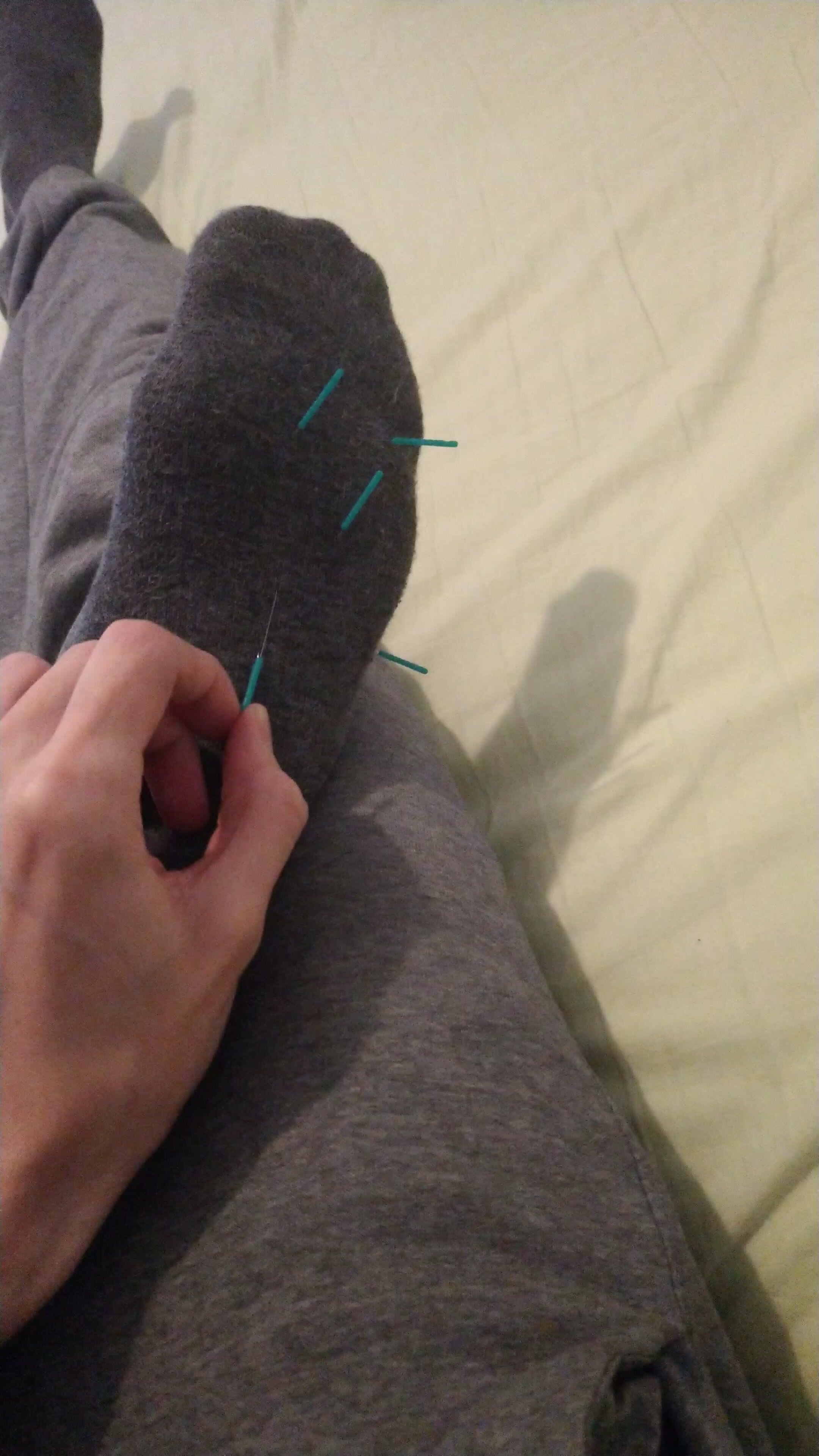 Removing acupuncture needles from foot