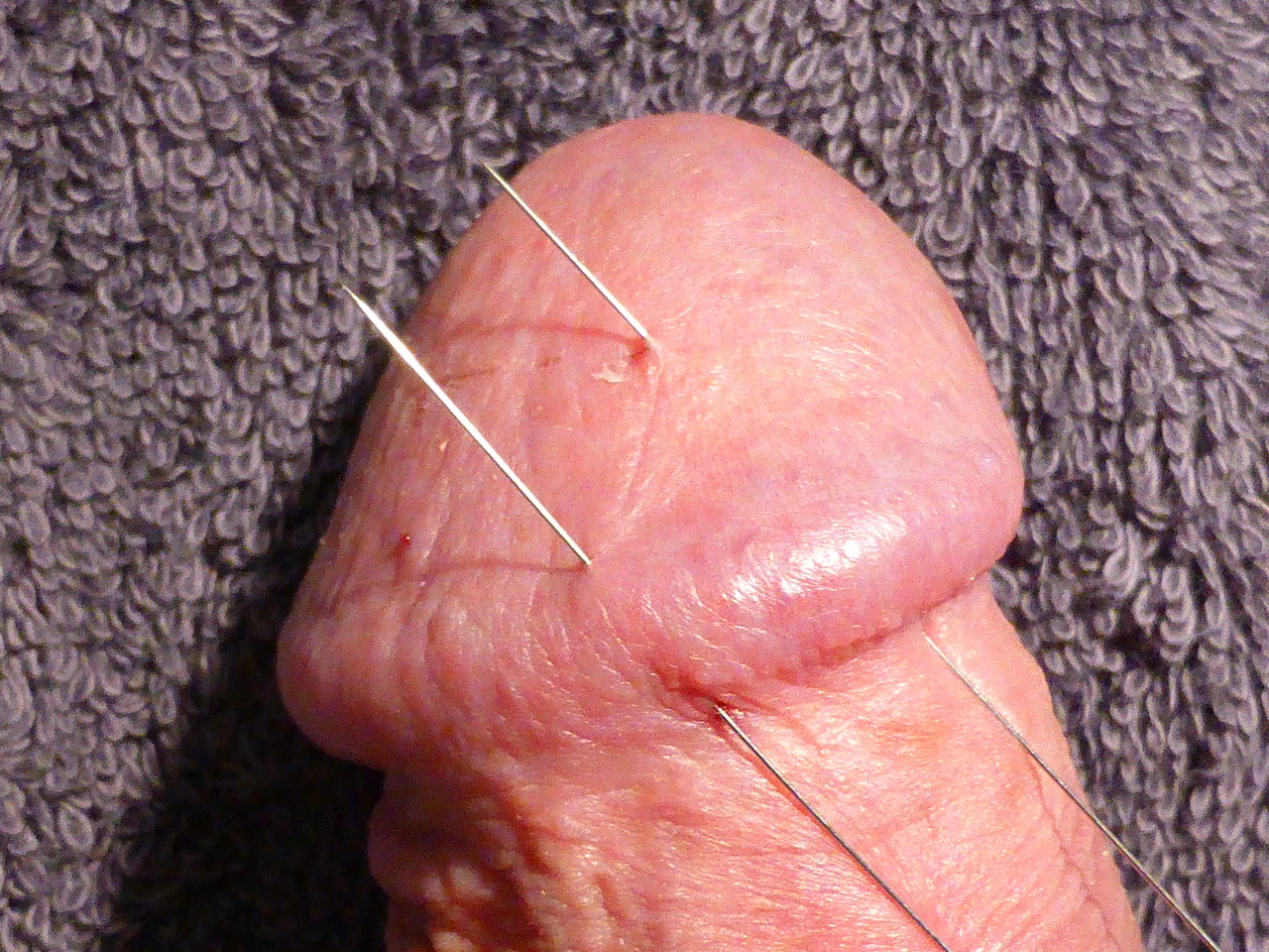 CBT - Acupuncture Needles