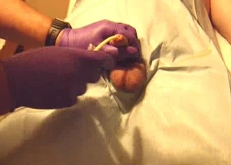 454px x 325px - The catheter is inserted into the penis - ThisVid.com