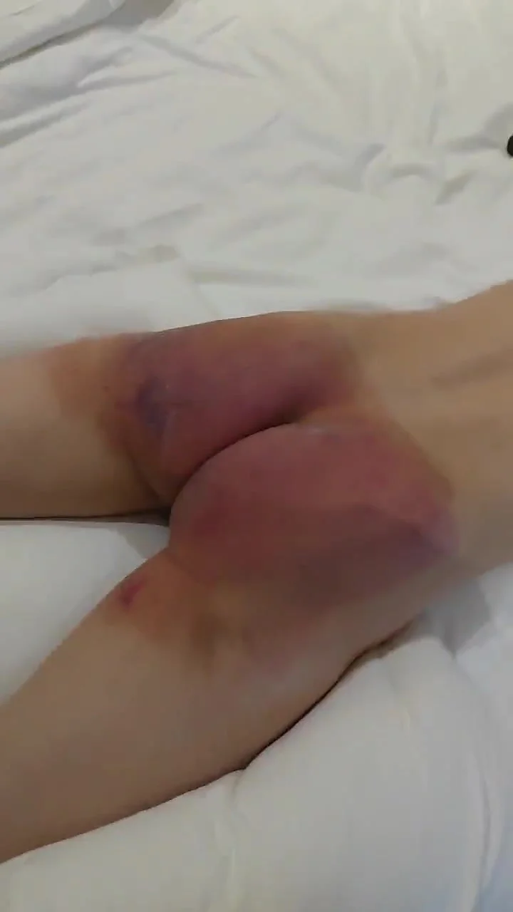Belt Whipping Girl Bdsm Bruises - Bruised butt takes more brutal spanking with a strap - ThisVid.com