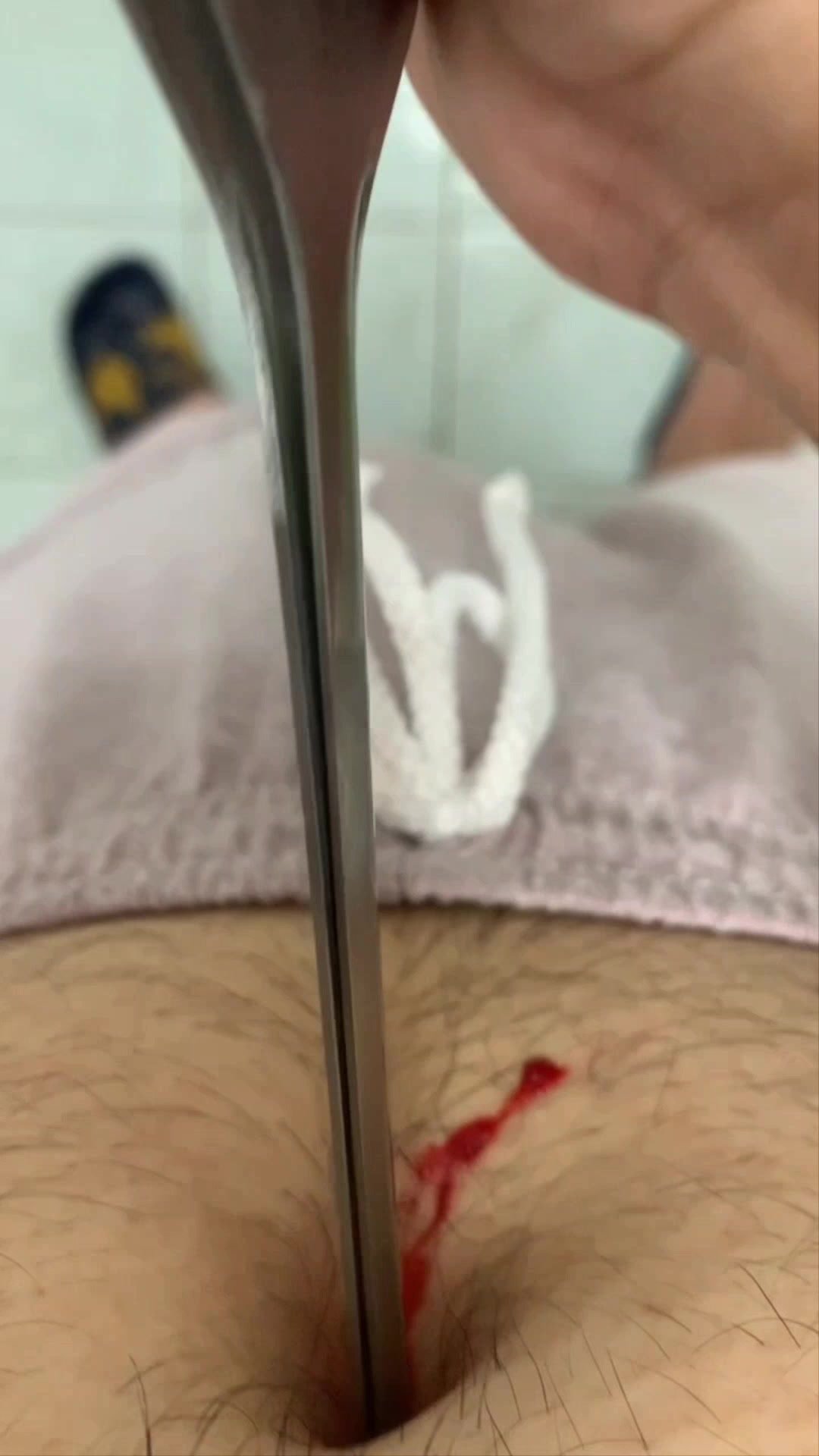 Clamp stabbed into navel deeply