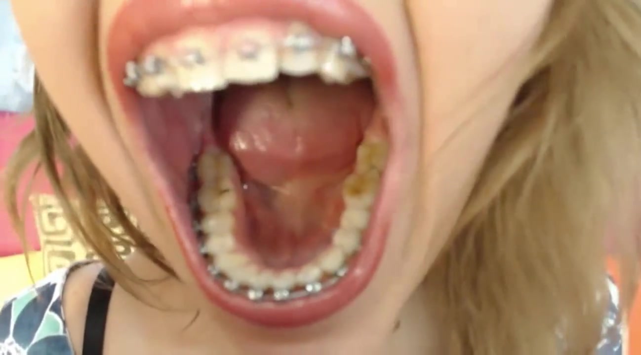 Braces Girl Webcam Mouth Tour
