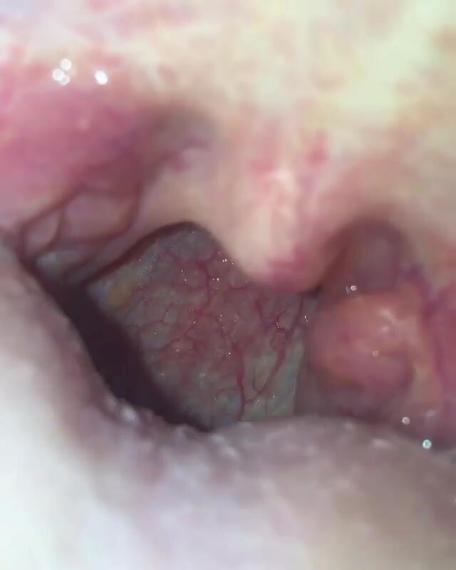 uvula close up - video 2
