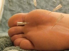 Needles in Young Male Feet