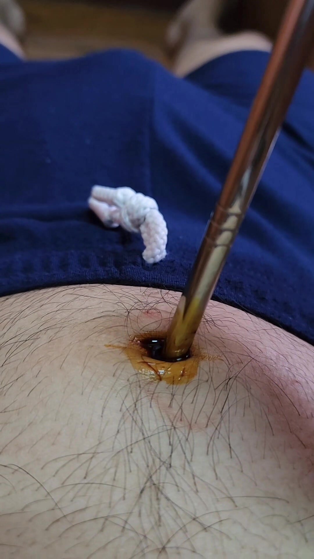 Stab navel repeatedly and clean