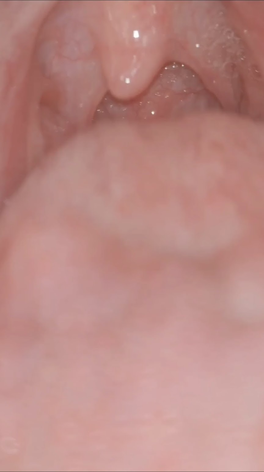 Girl shows her uvula and coughs