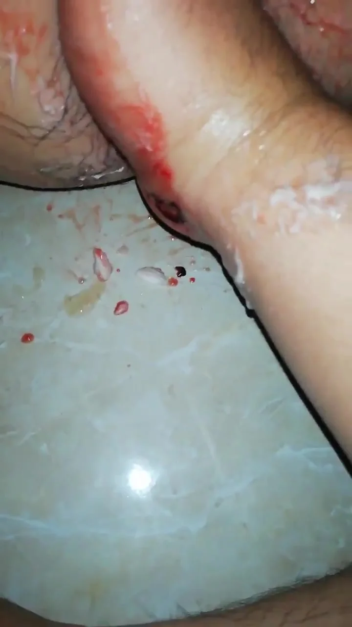 Anal Fist Blood - Fisting Bloody Hole - ThisVid.com