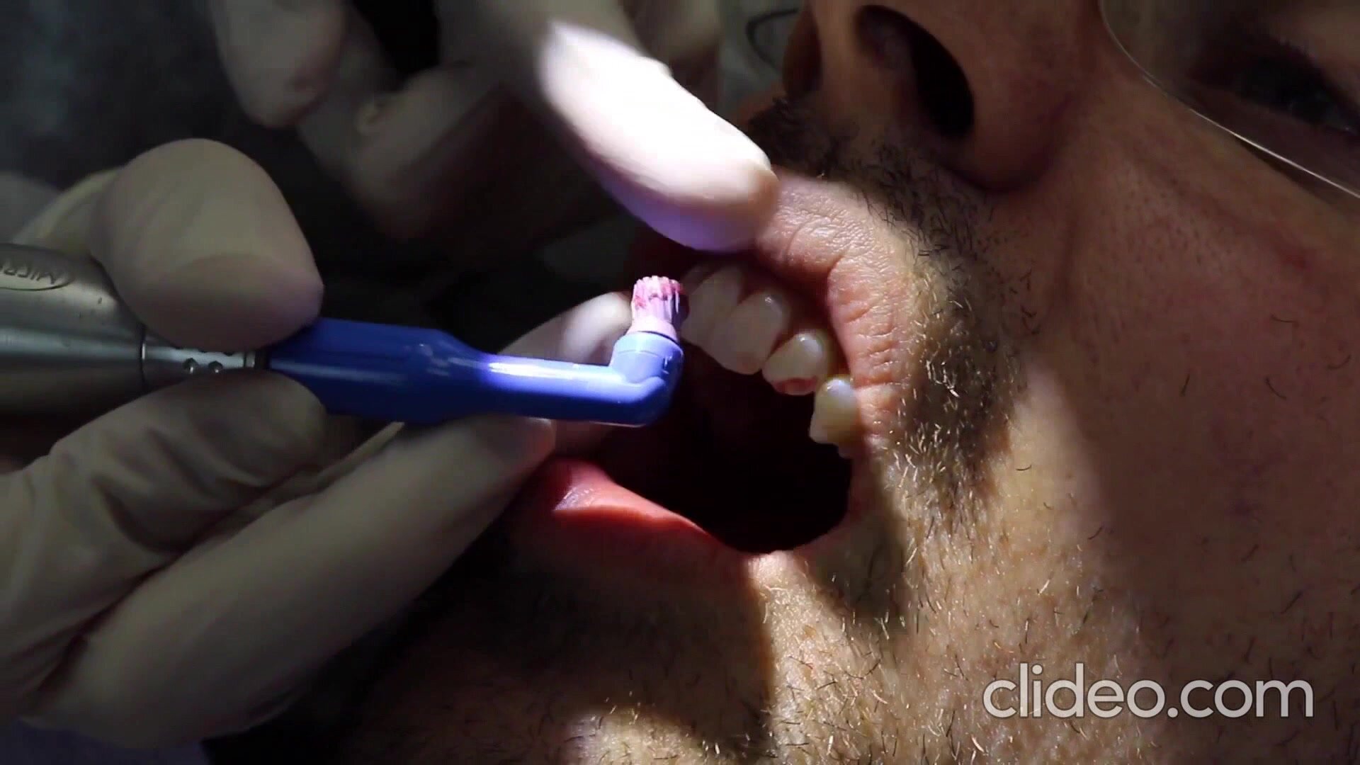 Male mouth at dentist teeth polished teeth