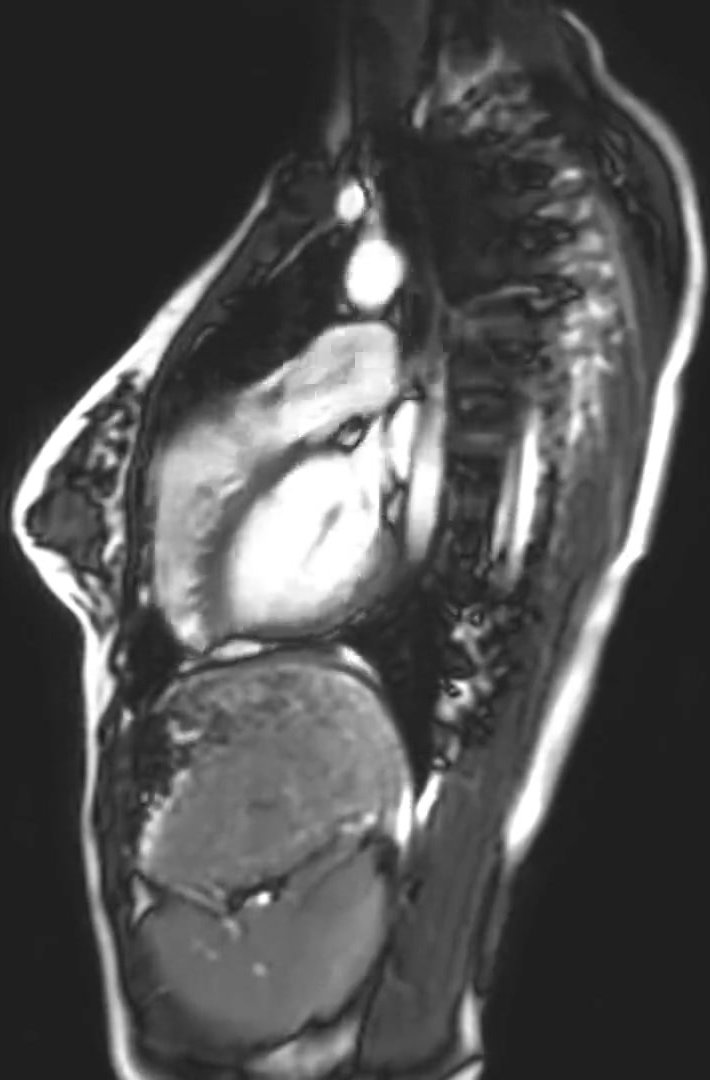 Female Heart MRI