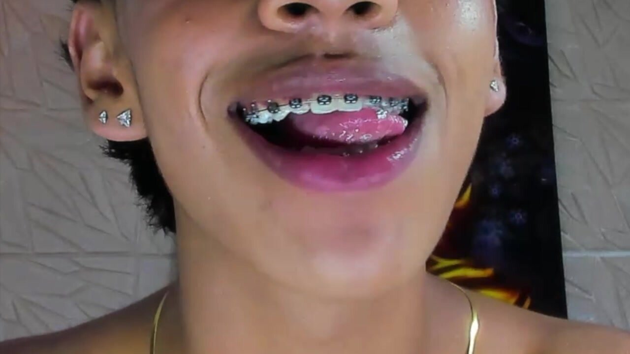 braces boy 1