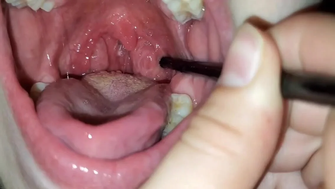 1136px x 640px - Tonsil stones girl compilation - ThisVid.com