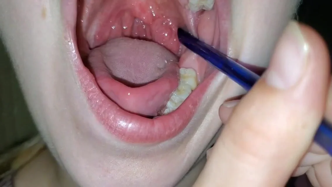 1136px x 640px - Tonsil stones girl compilation - ThisVid.com