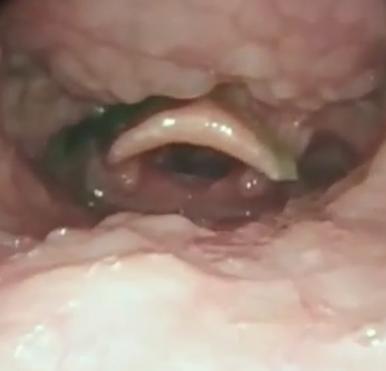 the throat - video 2