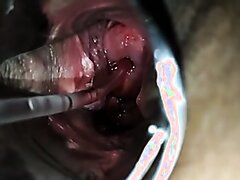 teen girl pulls large tube from cervix