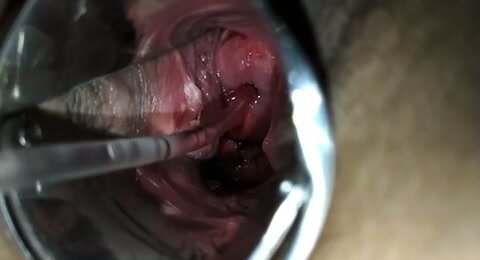 teen girl pulls large tube from cervix
