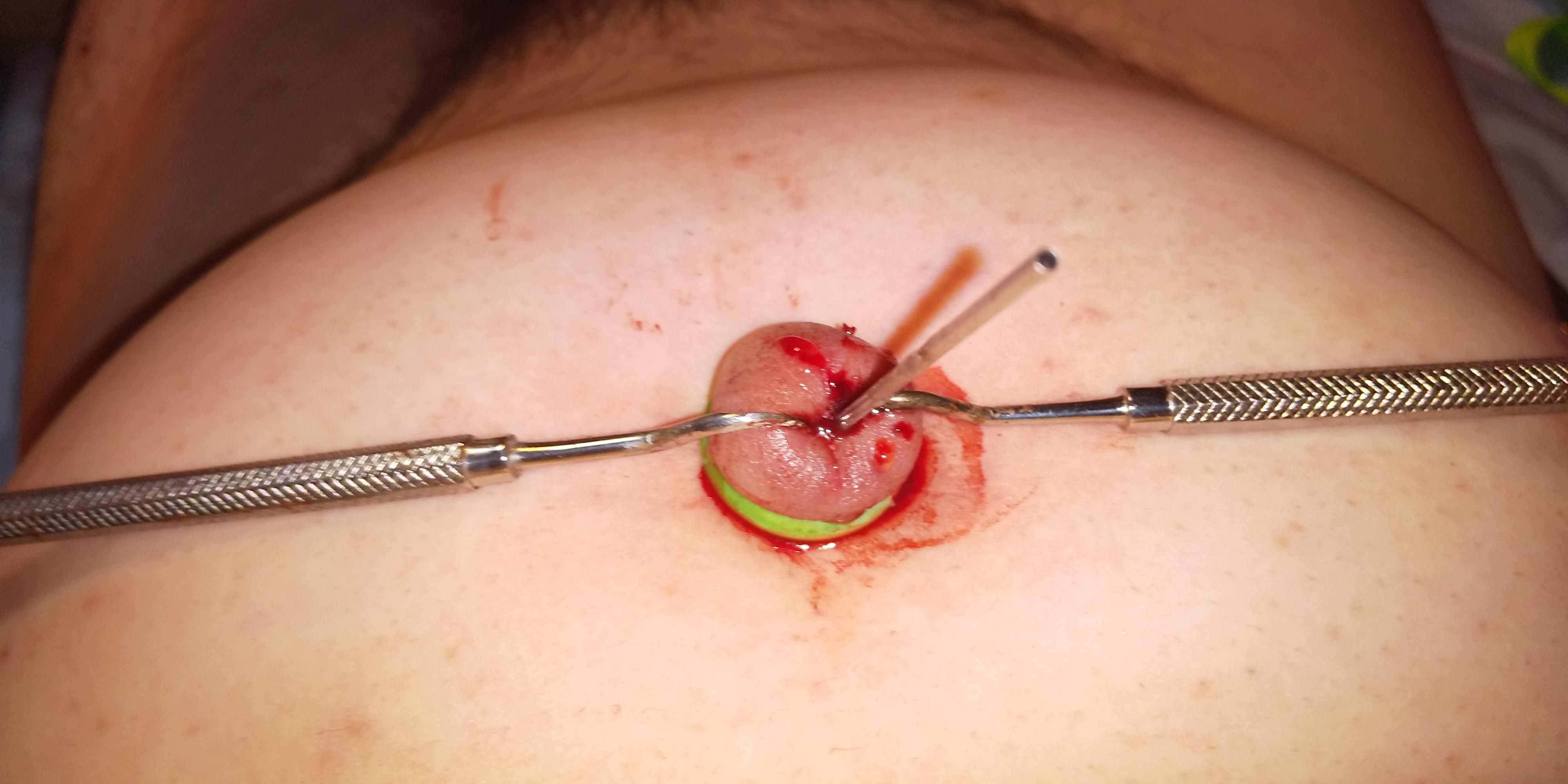 Navel lynching