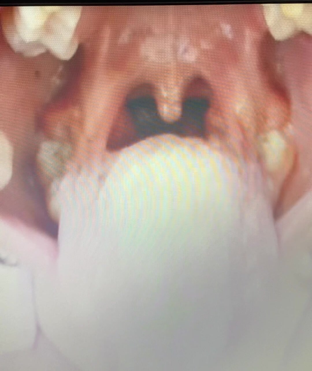 girl throat epiglotis close up.