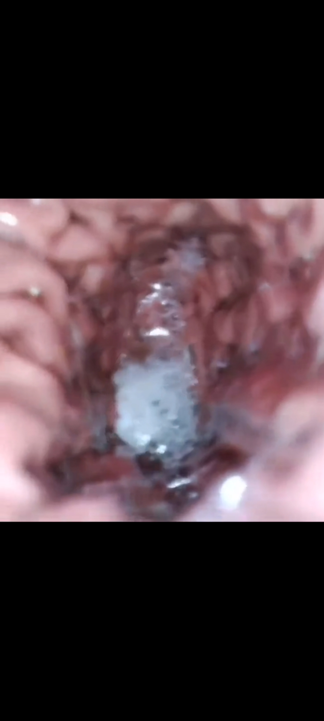 inside stomach - video 2