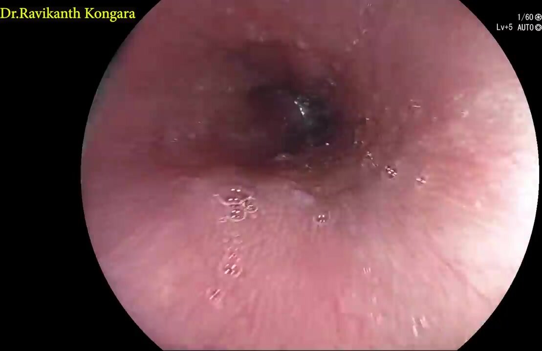 Endoscope vore - video 2