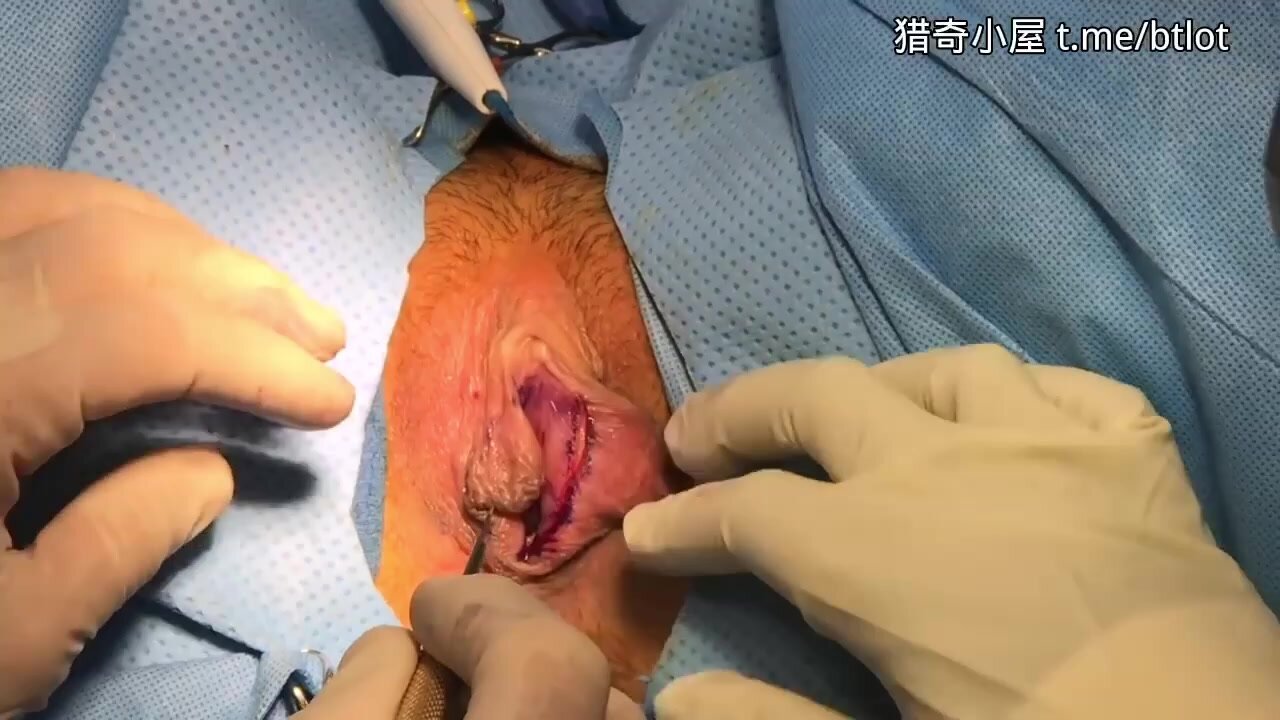 female circumcision - video 2