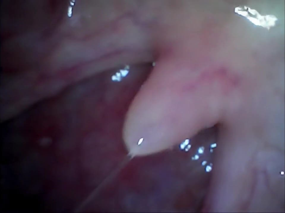 endoscope - video 9