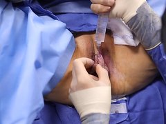 Vaginal Cosmetic Surgery - video 2
