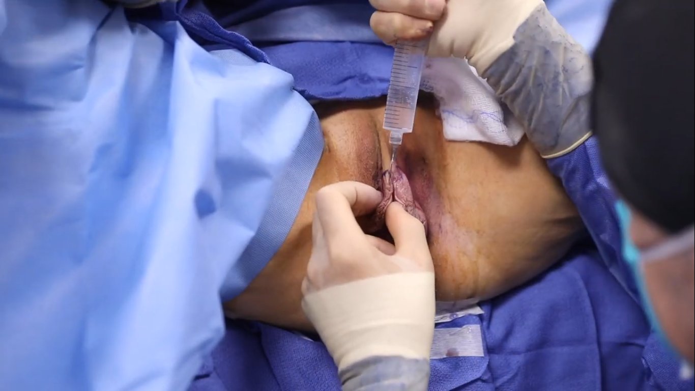 Vaginal Cosmetic Surgery - video 2