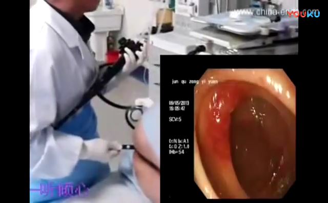 肠镜手法视频