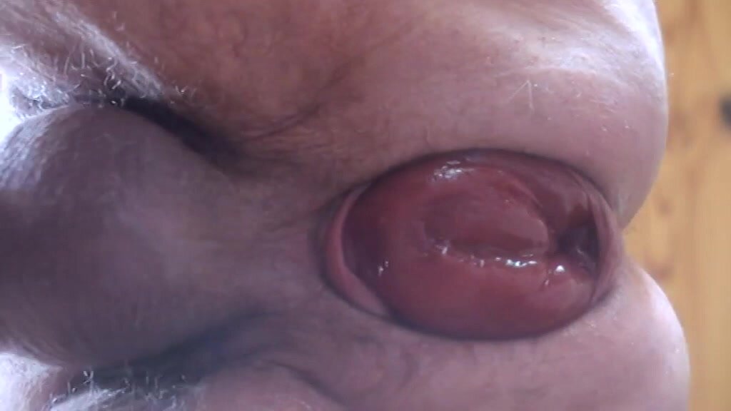 prolapse from bottom