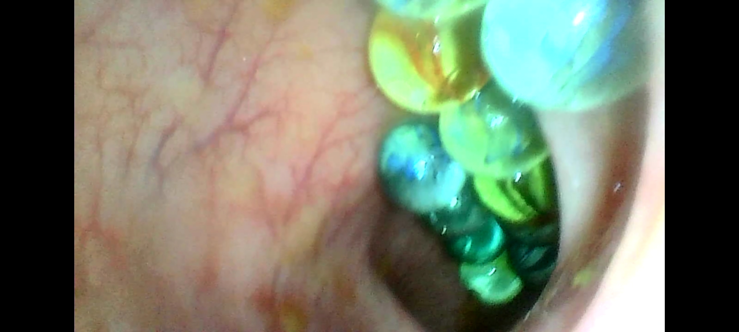 Marbles rolling inside my colon (endoscope)