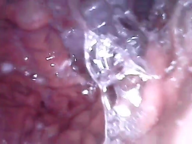 endoscope - video 4