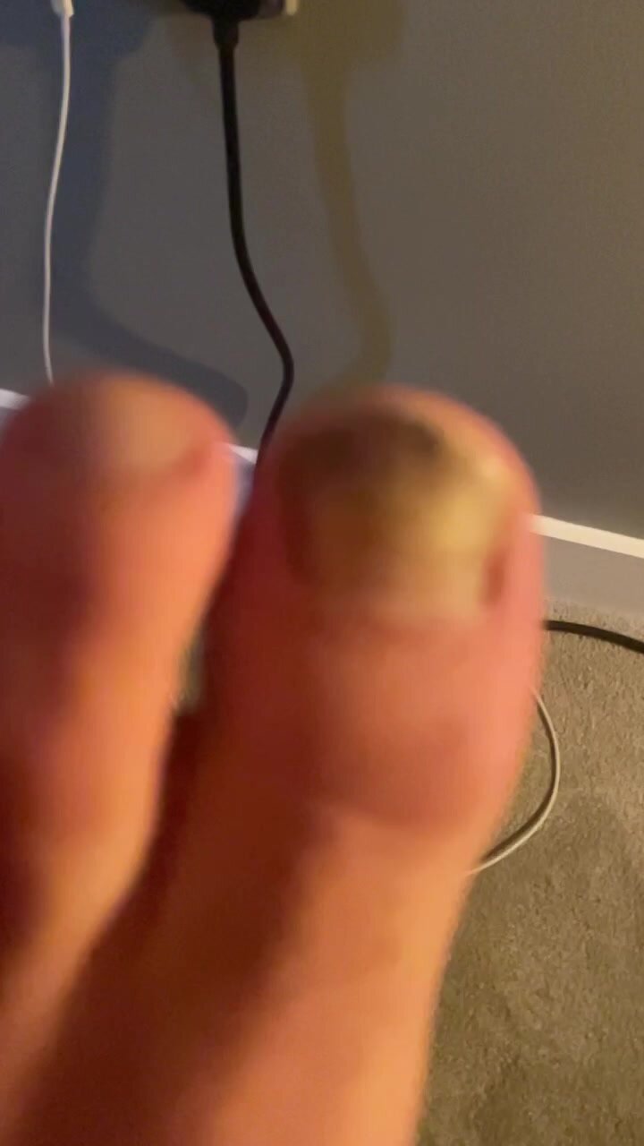 Verbal toenail fungus and stinky feet