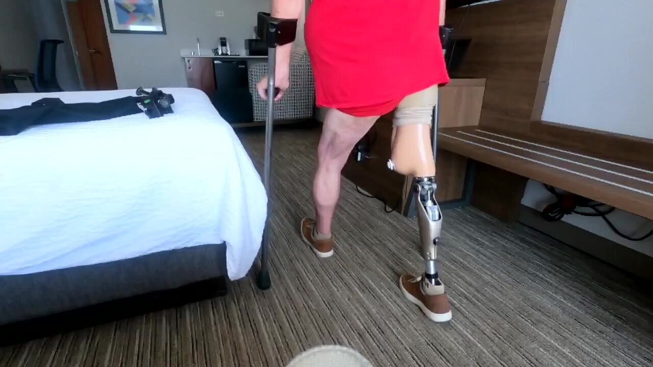 Polio Amputee Walks With Prosthesis
