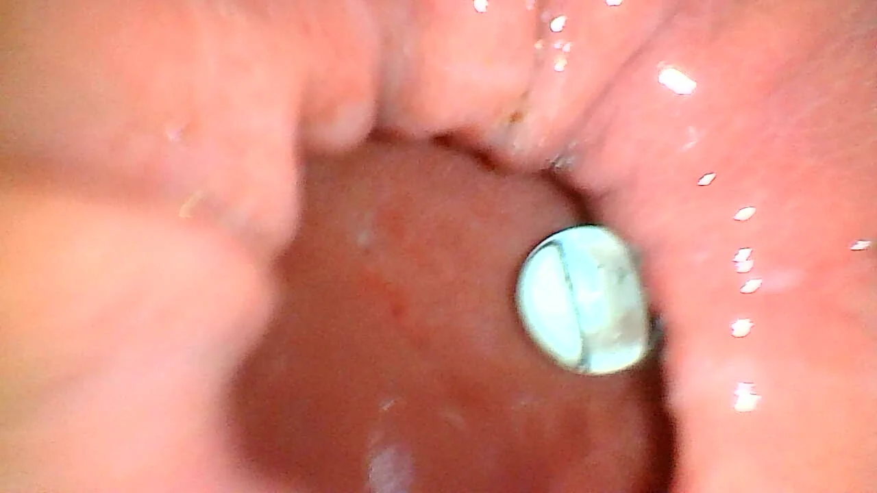 Stomach endoscope with a few marbls inside ThisVid com 