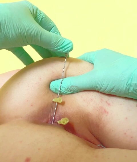 Anal needle fucking part 2