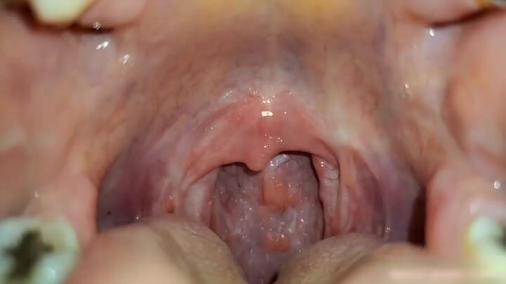 Mouth uvula exam