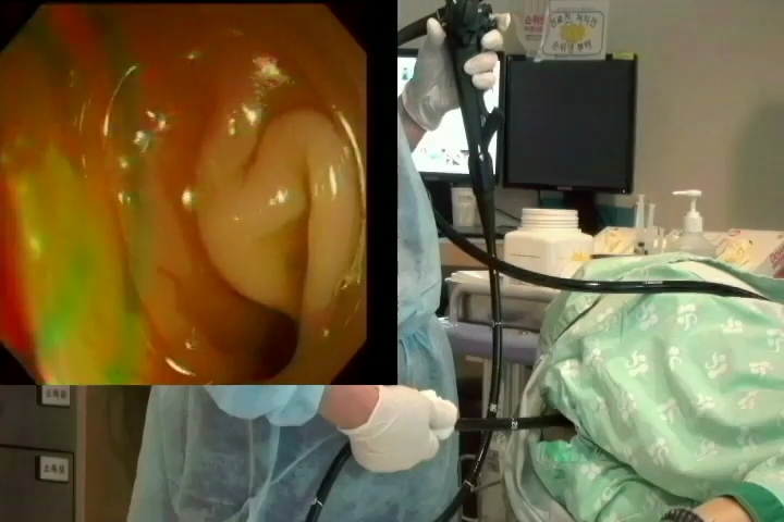 korean colonoscopy basic skill video - video 2
