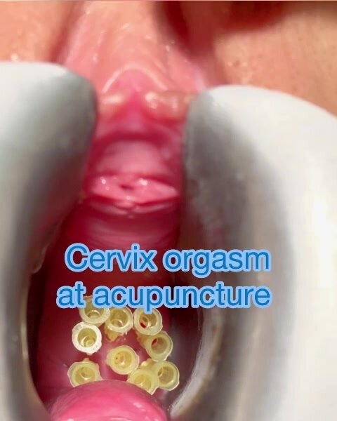 Cervix orgasm through acupuncture 1/2