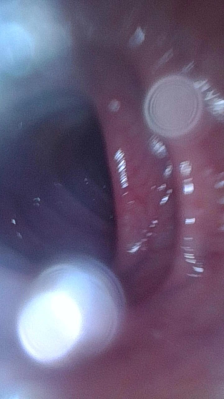 Colonoscopy For A Female Friend Video 2