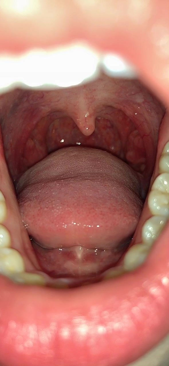 Asian Tongue and throat