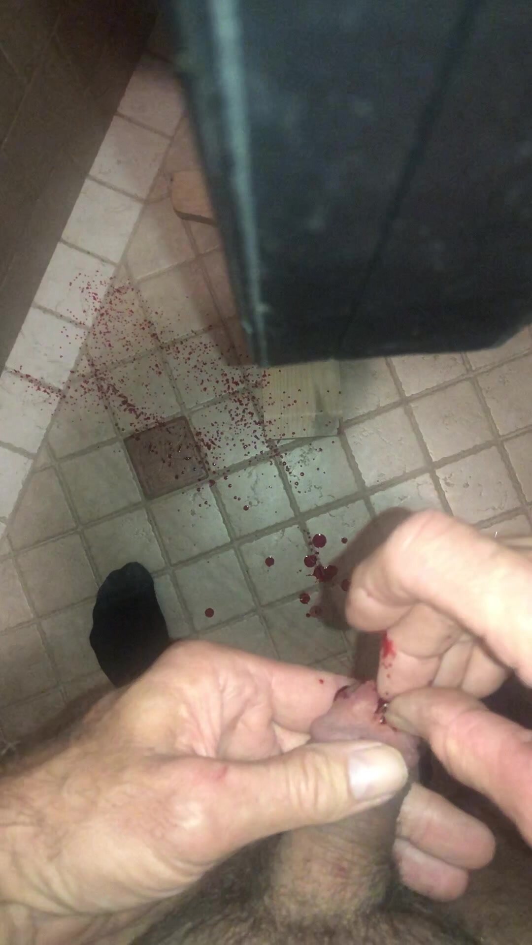 Staples removed from cock head