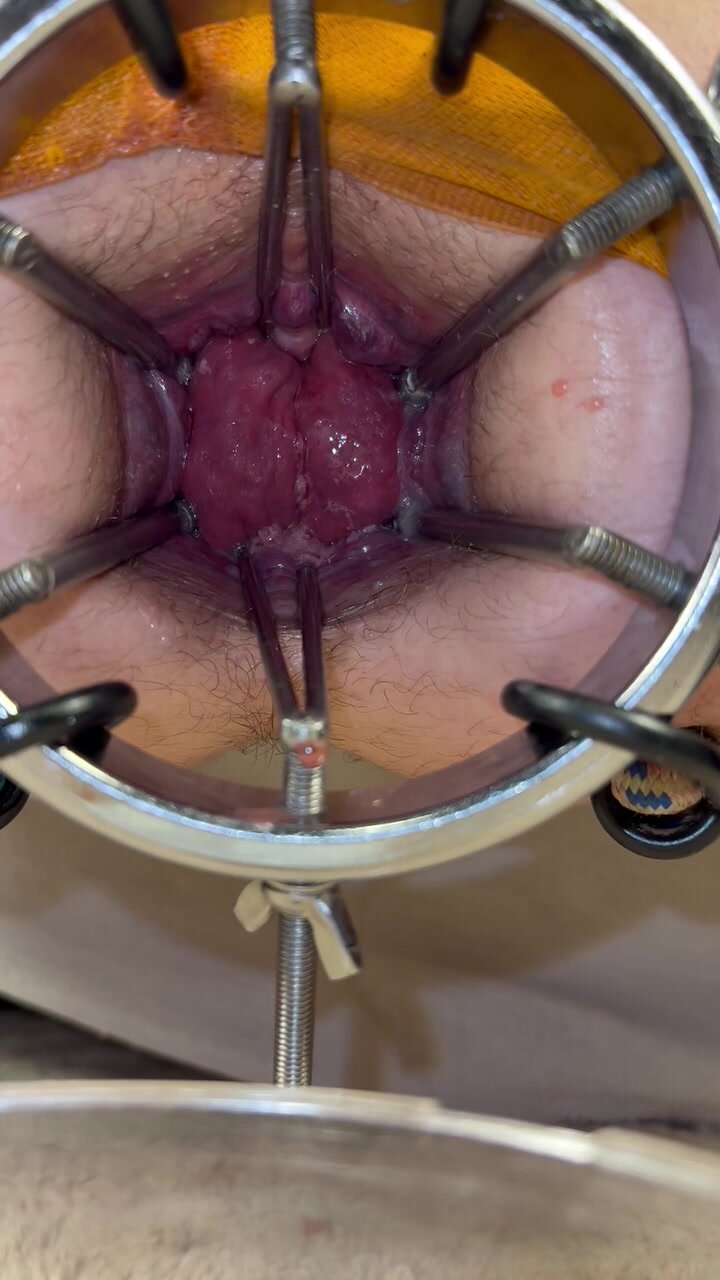 speculum opens my hole to reveal juicy prolapse