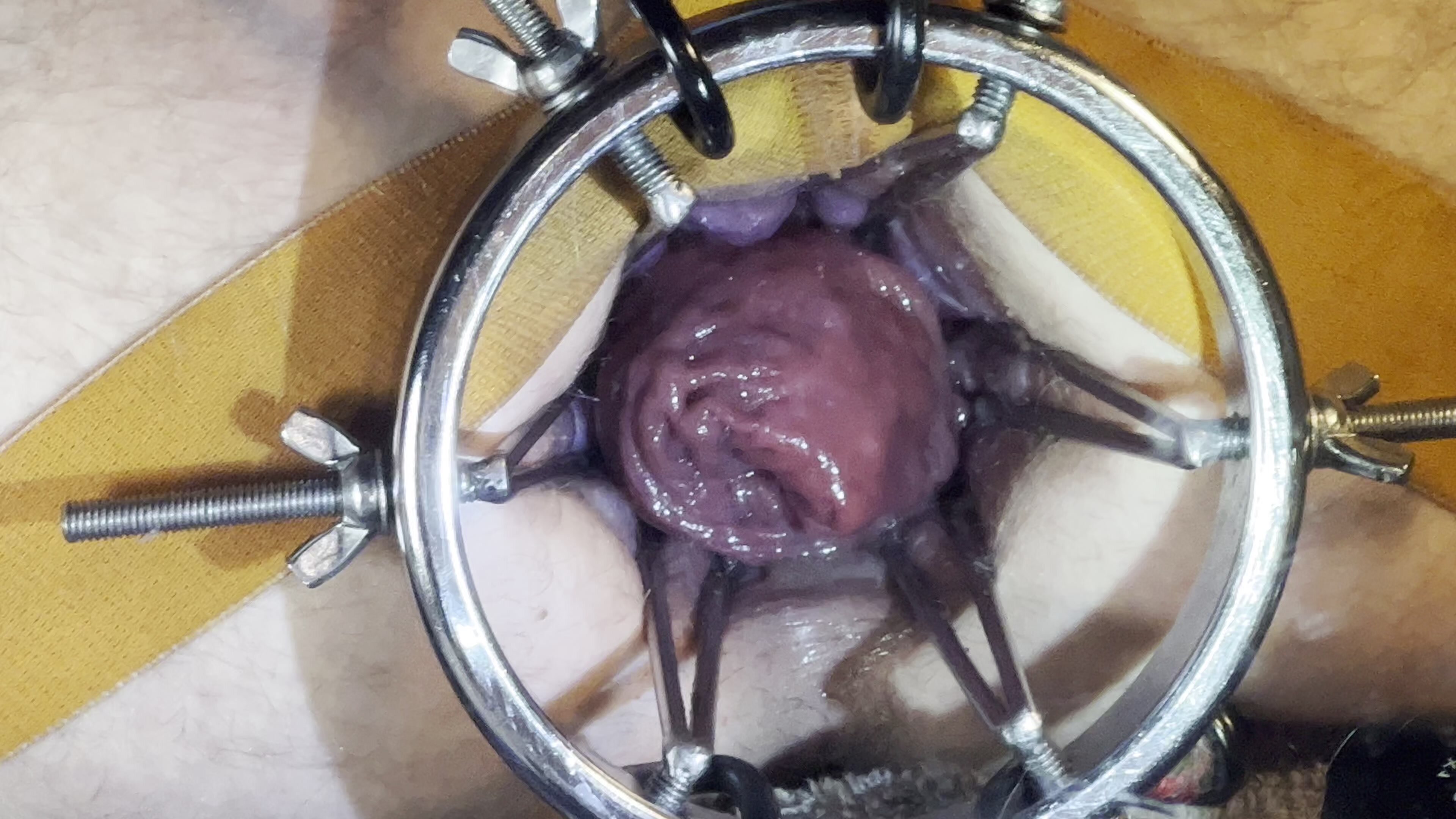 monster prolapse falling out of speculum