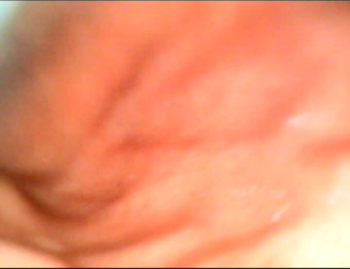 New endoscope swallow stomach ube