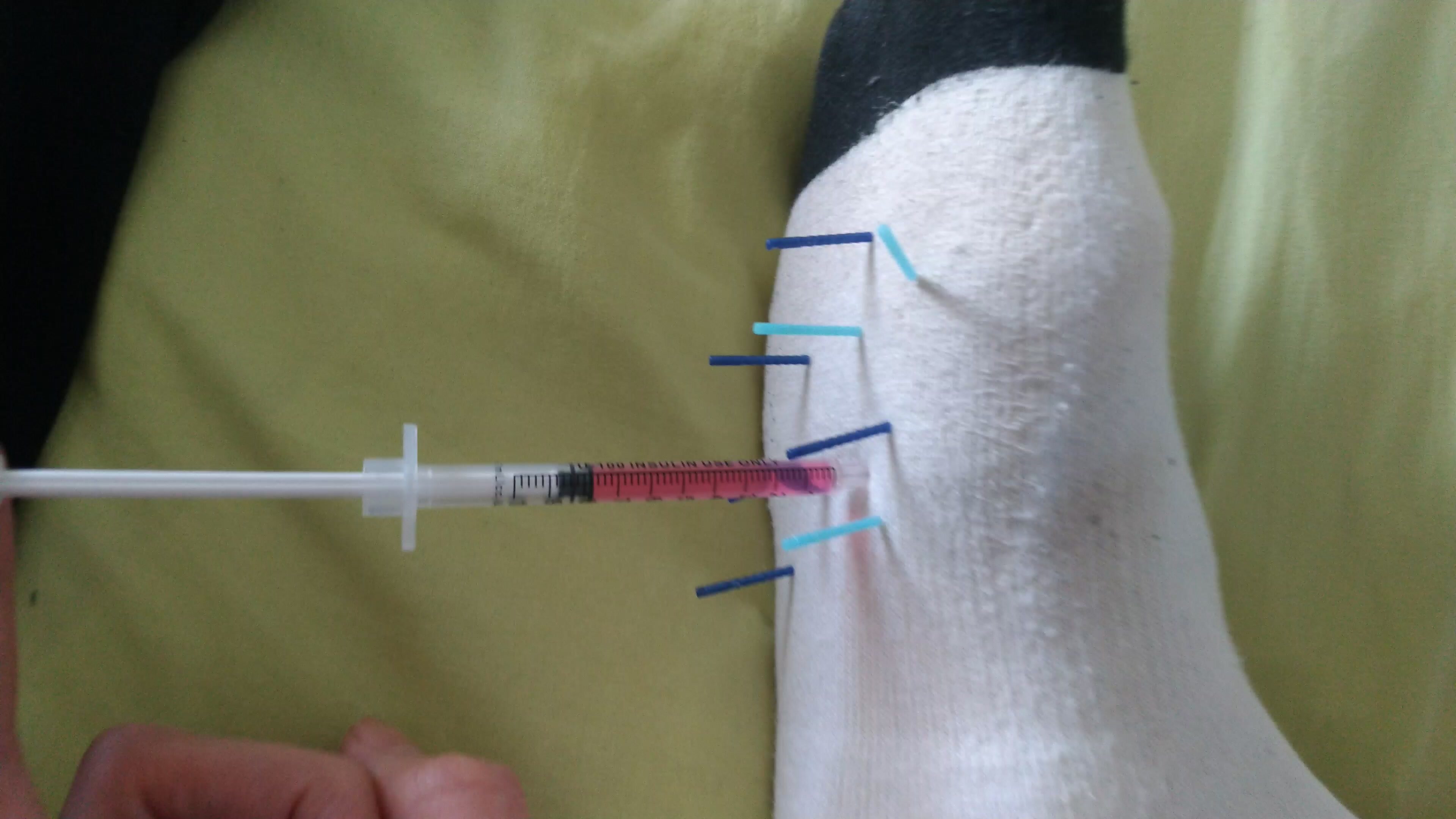 Foot injection during acupuncture