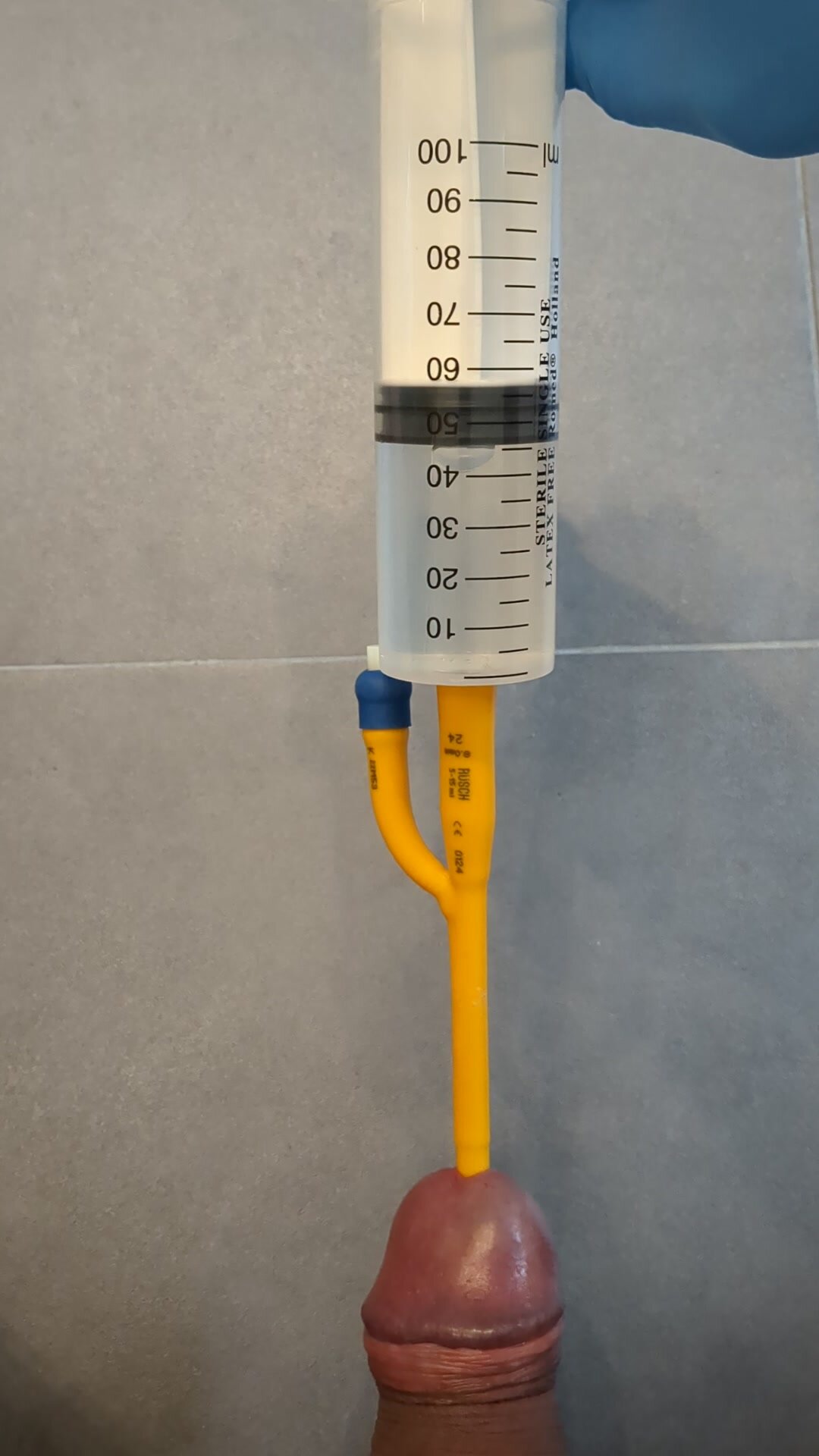 Bladder filling (CH 24 catheter)