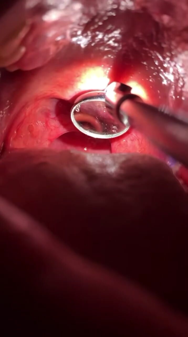 Video inside mouth